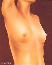 breast augmentation virginia washington dc maryland