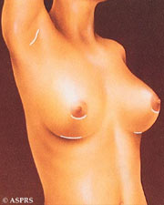 breast implants virginia washington dc maryland