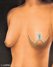 breast lift maryland washington dc virginia