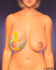 breast reduction md dc va